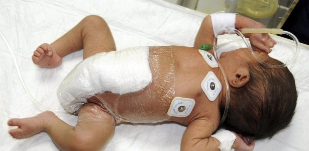 Imagem divulgada pelo Instituto Paquistanês de Saúde Infantil mostra bebê que nasceu com seis pernas, logo após cirurgia que removeu os membros sobressalentes. A criança, de uma semana de vida, está em um hospital da cidade de Karachi