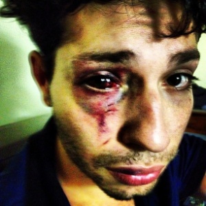 O cantor David Alvarez publicou foto no Facebook de seu rosto após a agressão