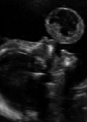 Em exame realizado às 17 semanas de gravidez, mãe viu 'bolha' saindo da boca do feto