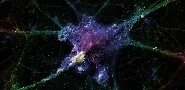Neurônio sob o efeito da proteína beta-amiloide, que gera as chamadas placas de senilidade, que, acredita-se, seriam as principais causas do Alzheimer