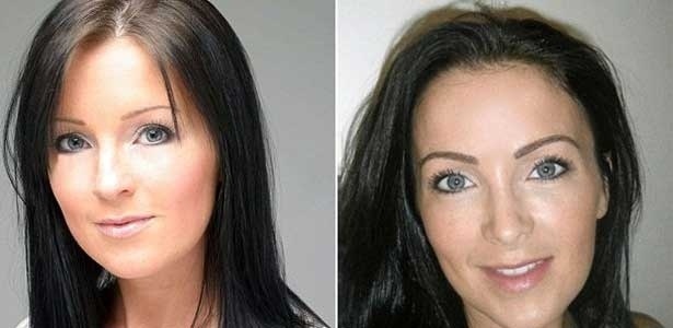 A britânica Claire Culverwell antes (à esq.) e depois da cirurgia de implante de sobrancelha