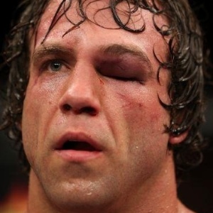 Norte-americano Kyle Kingsbury tem olho "fechado" por golpes e sua luta termina mais cedo