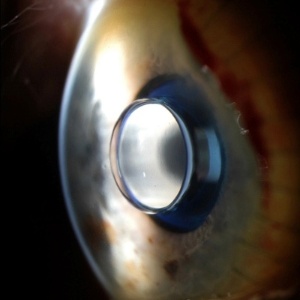 Micro-telescópio do tamanho de uma ervilha foi implantado sobre a retina 