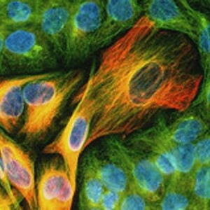 Segundo estudo, células de melanoma se tornam dependentes da droga vemurafenib