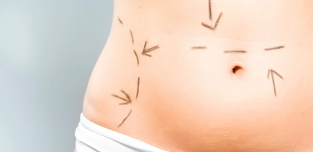 A lipoaspiração voltou a ser a cirurgia plástica mais realizada no Brasil, ultrapassando o aumento de mama