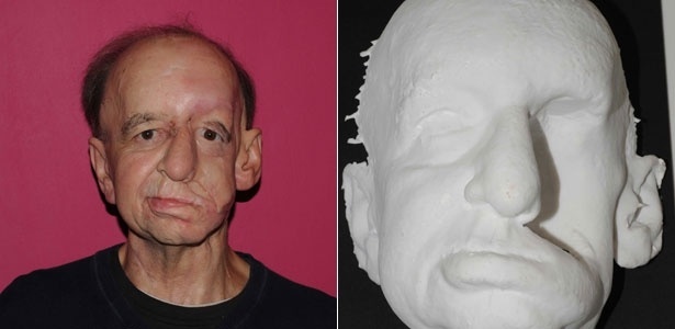 Eric Moger, 60, recebeu uma prótese facial para cobrir uma grande depressão causada por um tumor no rosto