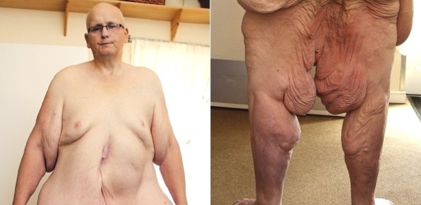 Britânico Paul Mason, que já pesou 444 quilos e está com 152, reclama de demora de serviço de saúde público em autorizar operação para retirada de excesso de pele