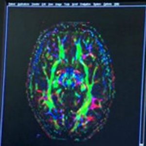 Ressonância magnética de cérebro de adolescente