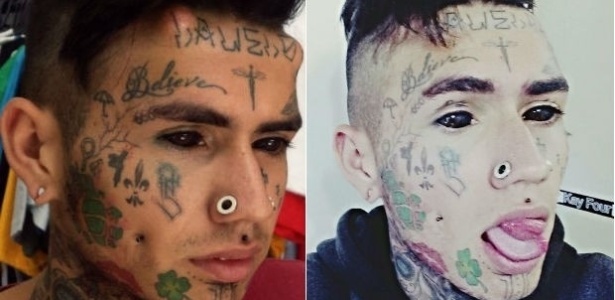 A foto à esquerda mostra o jovem de 18 anos com os chifres de silicone na testa; a imagem à direita retrata Bruno após a remoção dos implantes