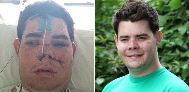 20.ago.2013 - Sam Fretwell sofreu 42 fraturas no rosto e passou por uma cirurgia de 13 horas para reconstituir a face