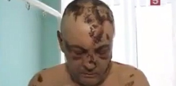 Foto mostra homem russo sofrendo os efeitos colaterais da droga "Krokodil". Centro de Controle de Intoxicações no Arizona (EUA) registrou dois casos da doença