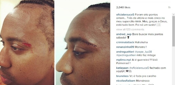  Arouca mostra machucado após choque de cabeça com atleta do Fluminense