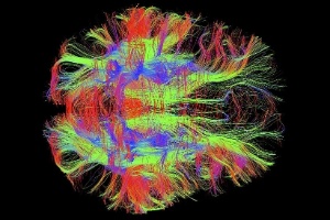 Ressonância magnética de fibras de nervos no cérebro de um adulto saudável