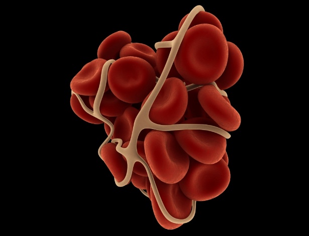 A TVP ocorre quando se forma um coágulo sanguíneo no interior das artérias ou veias profundas