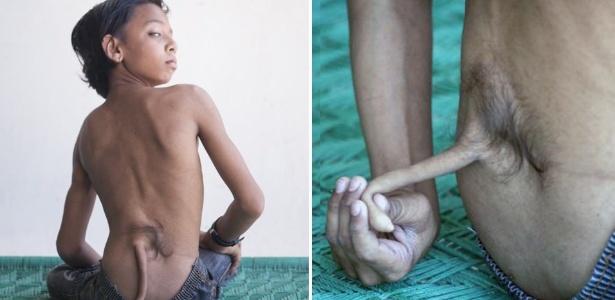 Arshid Ali Khan, 13, que tem algo semelhante a um ''rabo'' de cerca de 15 cm nas costas