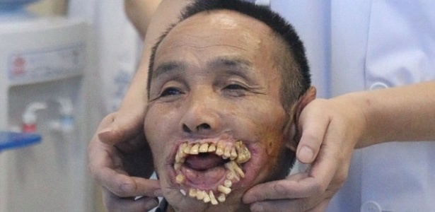 Cirurgia de Xiuyou Wu, 65, vai reconstruir lábios usando músculos das pernas