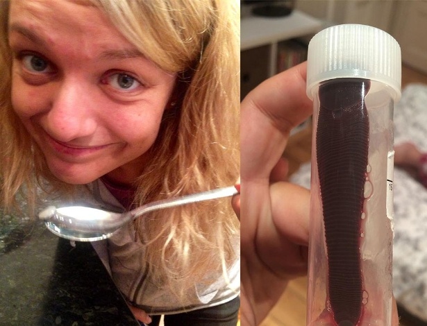 Daniela Liverani, 24, descobriu que uma sanguessuga de 7,5 centímetros estava vivendo dentro de seu nariz há cerca de um mês,época em que ela retornou de uma viagem ao sudeste da Ásia