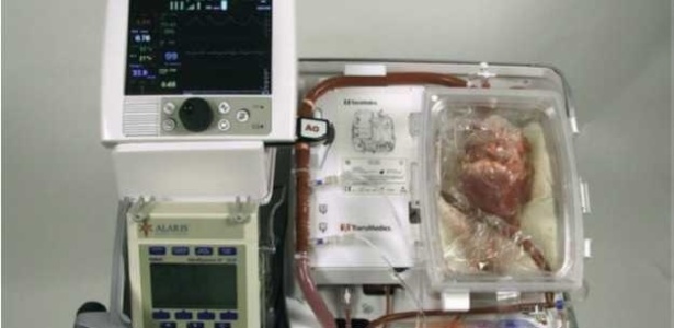 A máquina batizada de "coração em caixa" permitiu aos médicos manter o coração próprio para transplante
