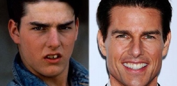 Diferenças nos dentes do ator Tom Cruise inspiraram pesquisa de dentista brasileiro