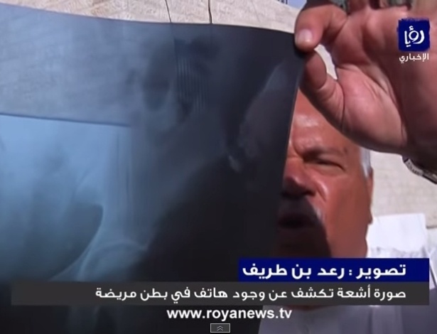 Homem segura raio-X que mostra objeto dentro do abdome 