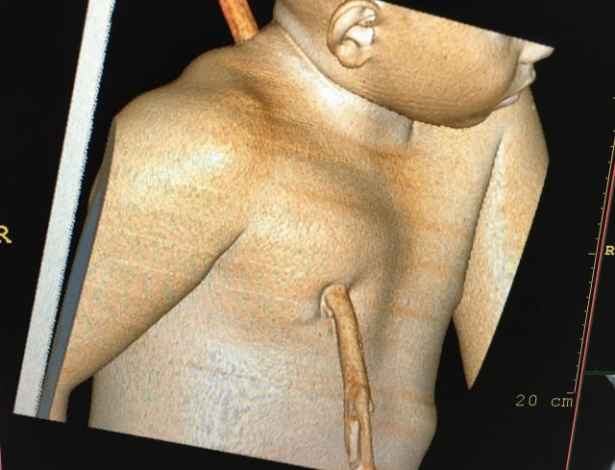 Tomografia computadorizada mostra o pedaço de madeira que atravessou o corpo do menino de 8 anos em acidente no interior do Piauí