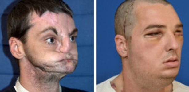 Richard Norris passou pelo transplante facial mais amplo já feito