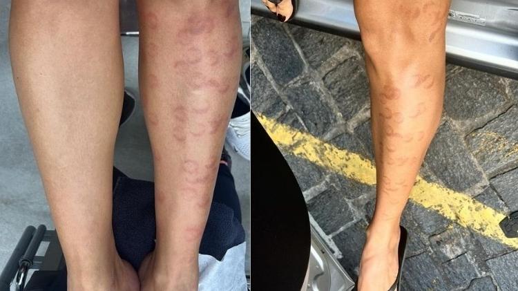 Perna esquerda de B&aacute;rbara logo ap&oacute;s procedimento