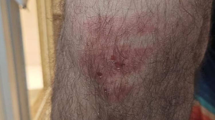 Após desmaio, fã acordou com queimaduras no joelho