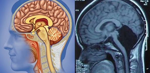 Imagem à esquerda mostra um cérebro comum com cerebelo. O raio-X da direita registra o cérebro da chinesa sem cerebelo