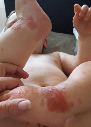 Amy Stinton postou foto do filho Oliver, que teria contraído herpes após beijo