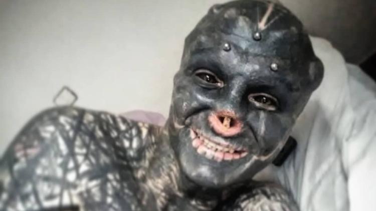 Anthony Loffredo, adepto da modificação corporal, após cirurgia para a remoção do nariz