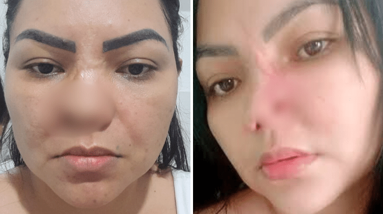 Mulher perde parte do nariz após cirurgia estética: “É assustador