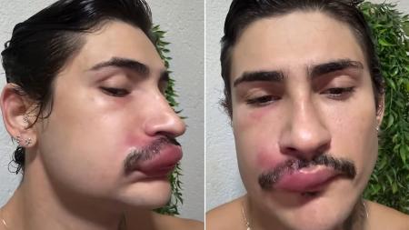 Influenciador Ken de CG é internado após espremer espinha na boca